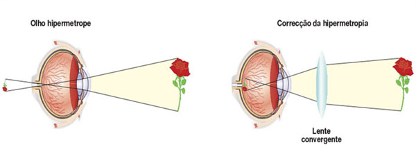 Como é um olho com falta de vista ao perto