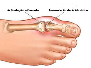 Inflamação da articulação do pé
